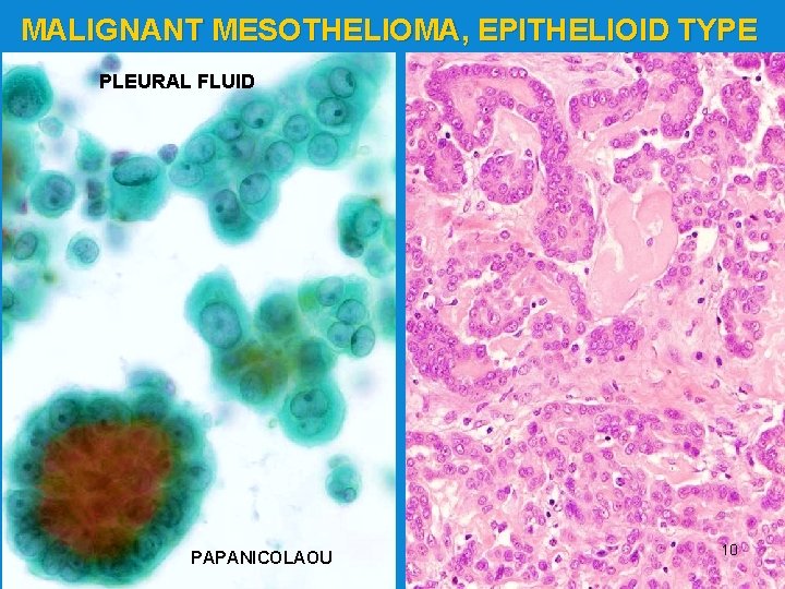 pleural mesothelioma cough