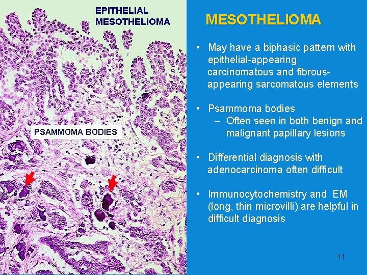 mesothelioma test diagnostic