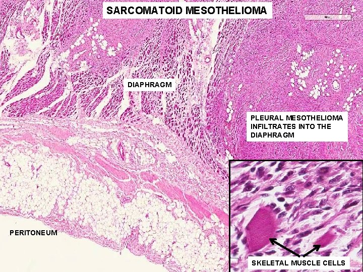 malignant pleural mesothelioma immunotherapy