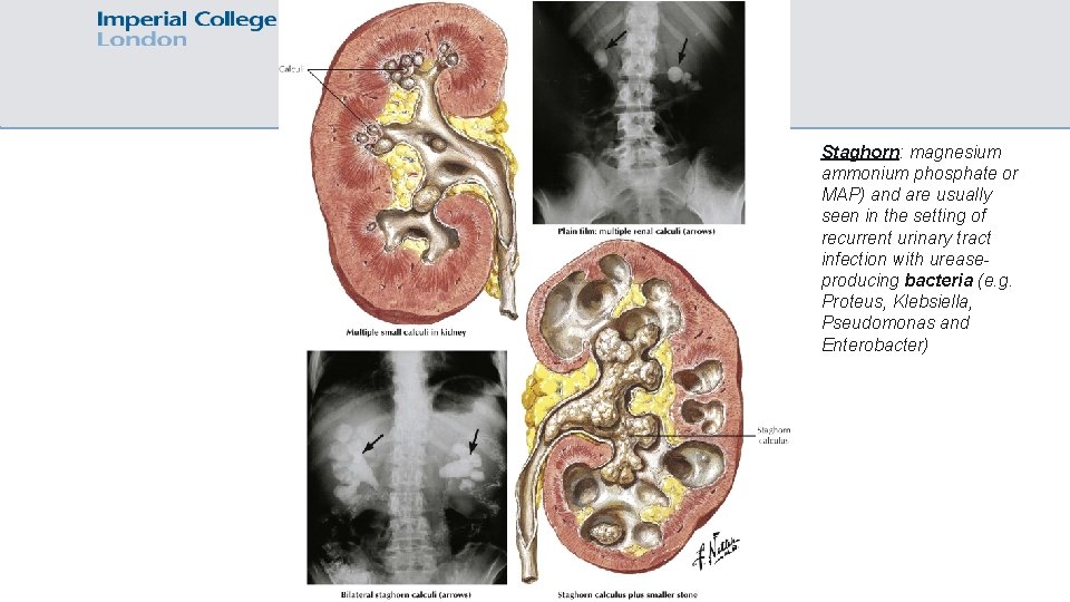 Staghorn: magnesium ammonium phosphate or MAP) and are usually seen in the setting of