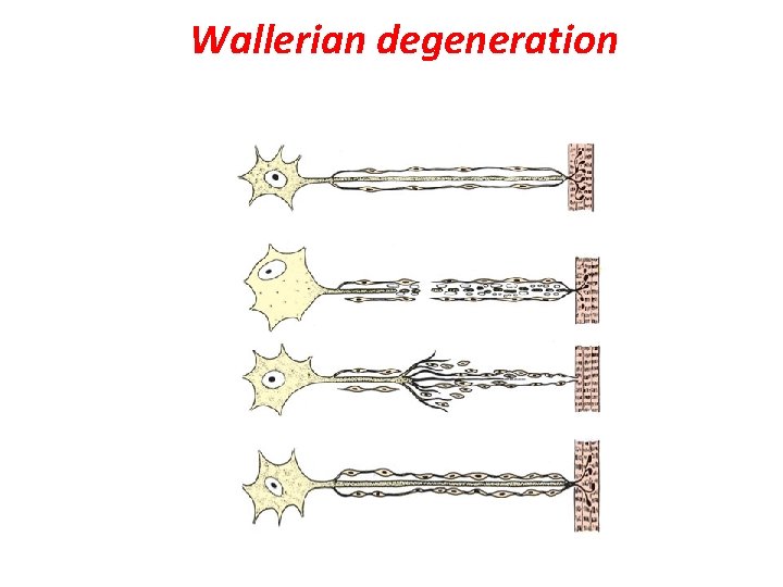 Wallerian degeneration 