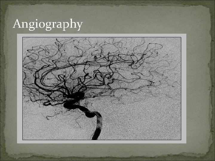 Angiography Angiography