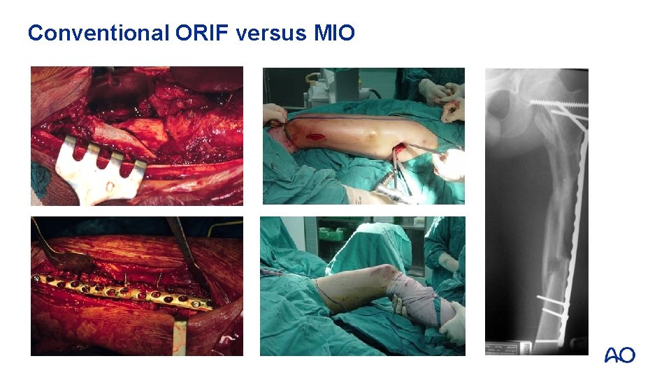 Conventional ORIF versus MIO 