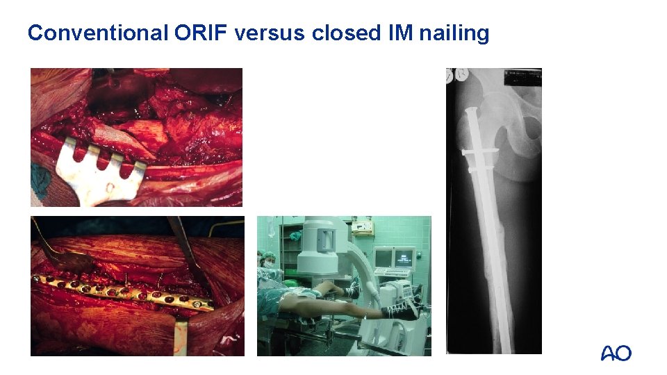 Conventional ORIF versus closed IM nailing 