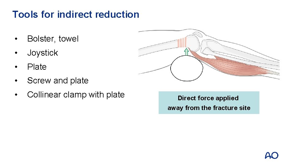 Tools for indirect reduction • Bolster, towel • Joystick • Plate • Screw and