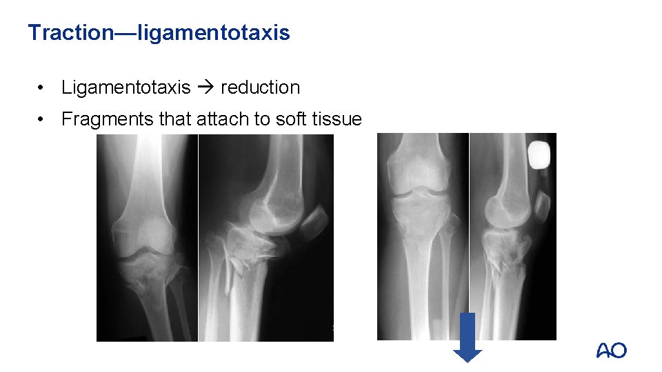 Traction—ligamentotaxis • Ligamentotaxis reduction • Fragments that attach to soft tissue 