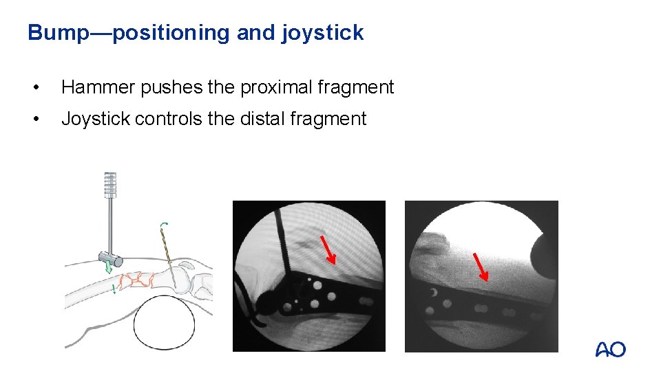 Bump—positioning and joystick • Hammer pushes the proximal fragment • Joystick controls the distal