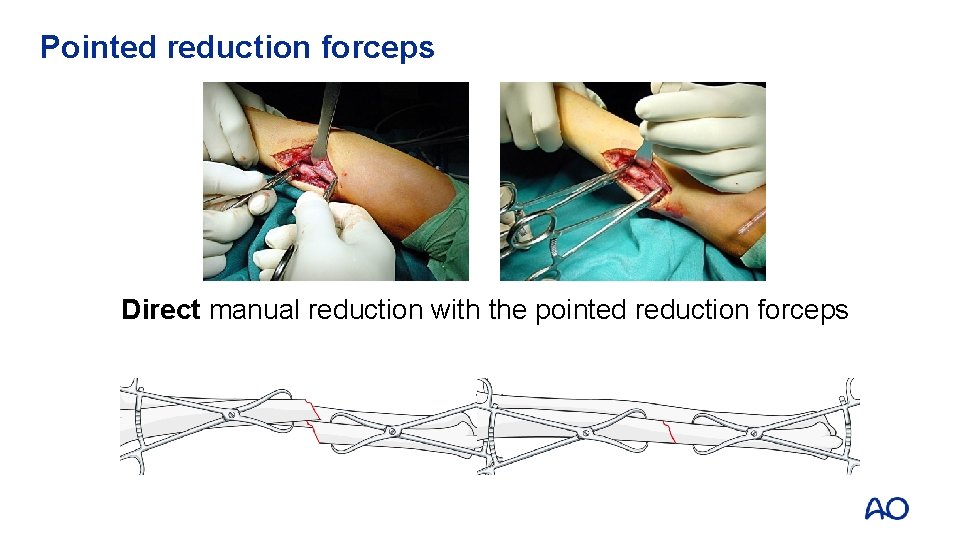 Pointed reduction forceps Direct manual reduction with the pointed reduction forceps 