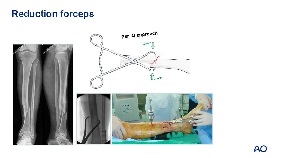 Reduction forceps roach Per~Q app 