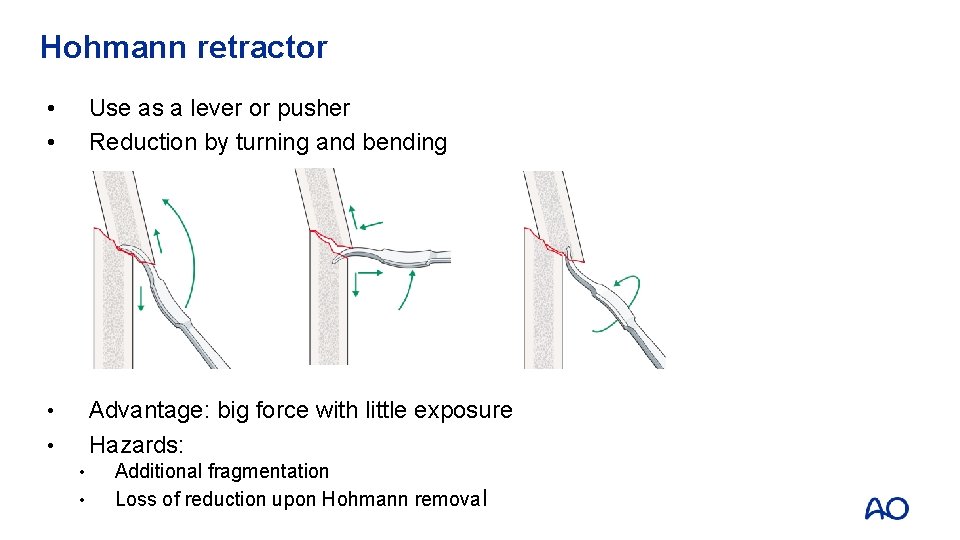 Hohmann retractor • • Use as a lever or pusher Reduction by turning and