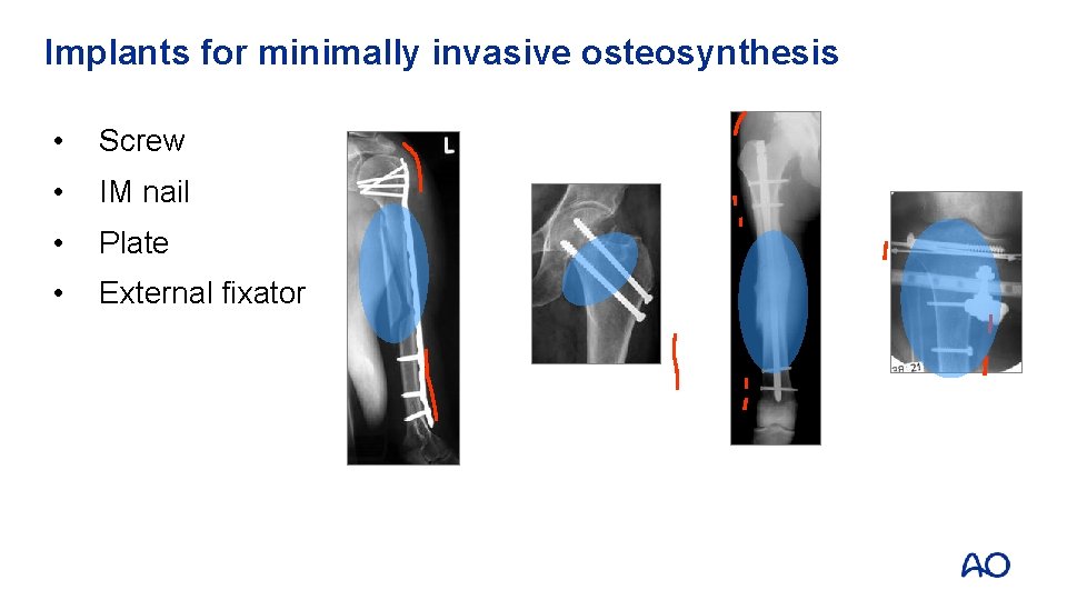 Implants for minimally invasive osteosynthesis • Screw • IM nail • Plate • External