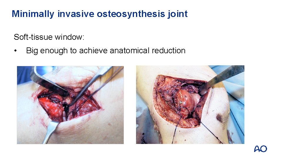 Minimally invasive osteosynthesis joint Soft-tissue window: • Big enough to achieve anatomical reduction 