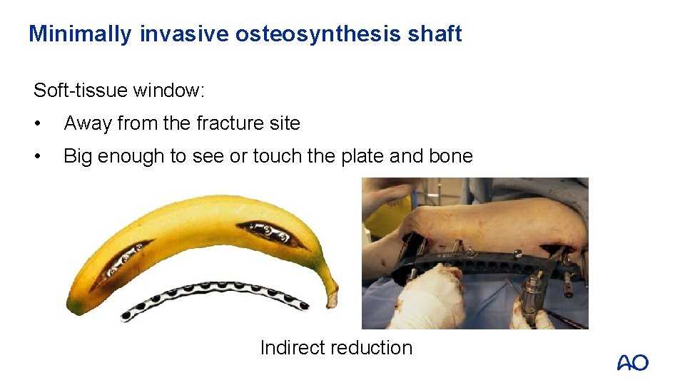 Minimally invasive osteosynthesis shaft Soft-tissue window: • Away from the fracture site • Big