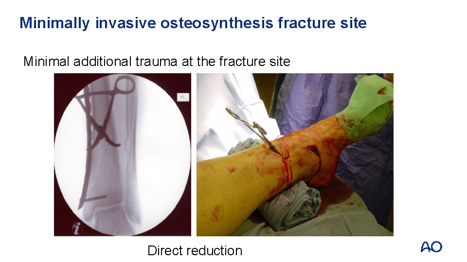 Minimally invasive osteosynthesis fracture site Minimal additional trauma at the fracture site Direct reduction