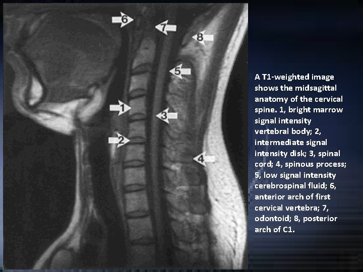A T 1 -weighted image shows the midsagittal anatomy of the cervical spine. 1, A T 1 -weighted image shows the midsagittal anatomy of the cervical spine. 1,