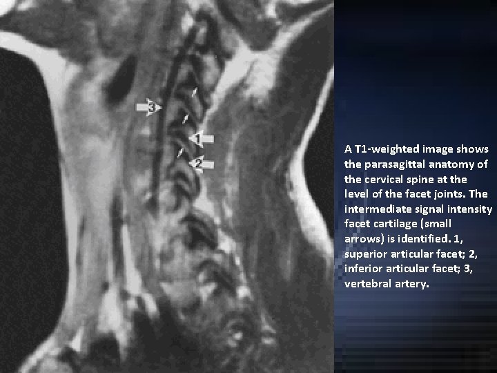A T 1 -weighted image shows the parasagittal anatomy of the cervical spine at A T 1 -weighted image shows the parasagittal anatomy of the cervical spine at