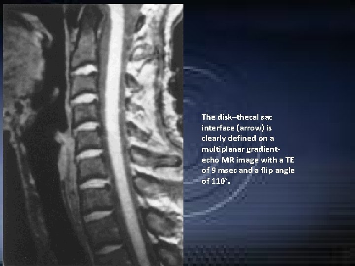The disk–thecal sac interface (arrow) is clearly defined on a multiplanar gradientecho MR image The disk–thecal sac interface (arrow) is clearly defined on a multiplanar gradientecho MR image