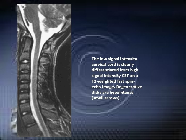 The low signal intensity cervical cord is clearly differentiated from high signal intensity CSF The low signal intensity cervical cord is clearly differentiated from high signal intensity CSF