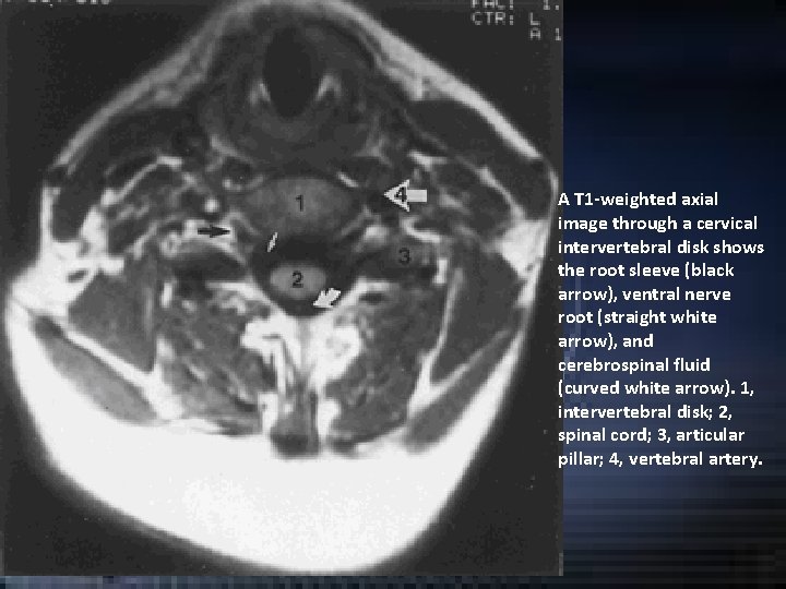 A T 1 -weighted axial image through a cervical intervertebral disk shows the root A T 1 -weighted axial image through a cervical intervertebral disk shows the root