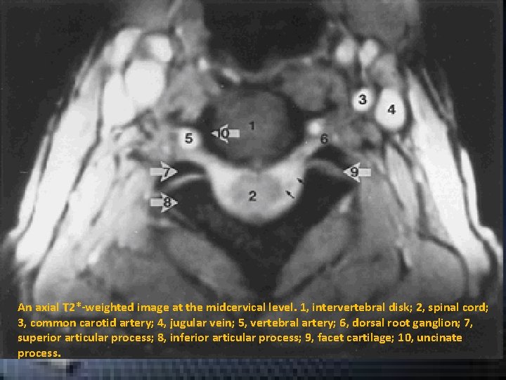 An axial T 2*-weighted image at the midcervical level. 1, intervertebral disk; 2, spinal An axial T 2*-weighted image at the midcervical level. 1, intervertebral disk; 2, spinal