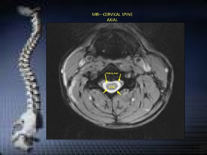 MRI– CERVICAL SPINE AXIAL THECAL SAC CORD MRI– CERVICAL SPINE AXIAL THECAL SAC CORD