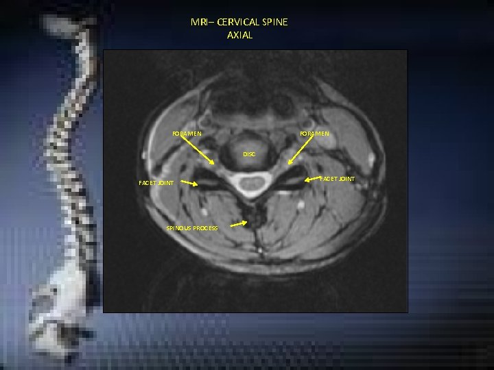 MRI– CERVICAL SPINE AXIAL FORAMEN DISC FACET JOINT SPINOUS PROCESS FACET JOINT MRI– CERVICAL SPINE AXIAL FORAMEN DISC FACET JOINT SPINOUS PROCESS FACET JOINT