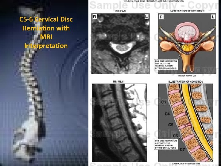 C 5 -6 Cervical Disc Herniation with MRI Interpretation C 5 -6 Cervical Disc Herniation with MRI Interpretation