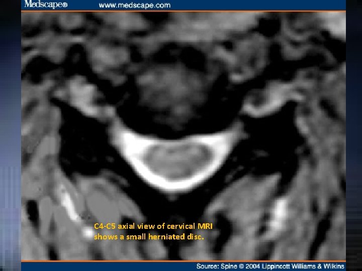 C 4 -C 5 axial view of cervical MRI shows a small herniated disc. C 4 -C 5 axial view of cervical MRI shows a small herniated disc.