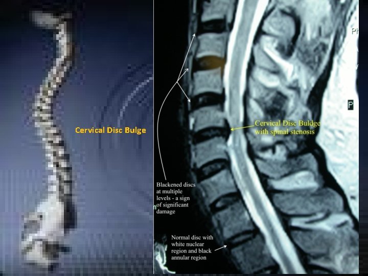 Cervical Disc Bulge Cervical Disc Bulge