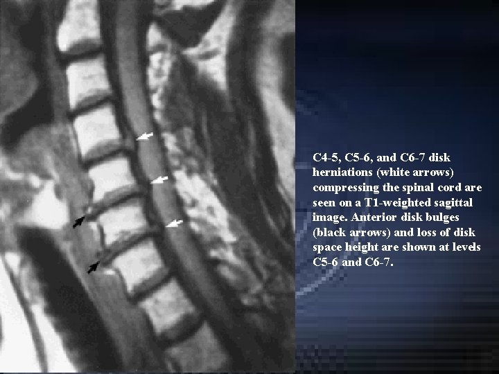 C 4 -5, C 5 -6, and C 6 -7 disk herniations (white arrows) C 4 -5, C 5 -6, and C 6 -7 disk herniations (white arrows)