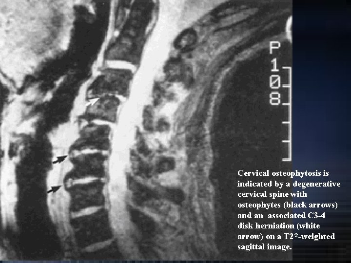 Cervical osteophytosis is indicated by a degenerative cervical spine with osteophytes (black arrows) and Cervical osteophytosis is indicated by a degenerative cervical spine with osteophytes (black arrows) and