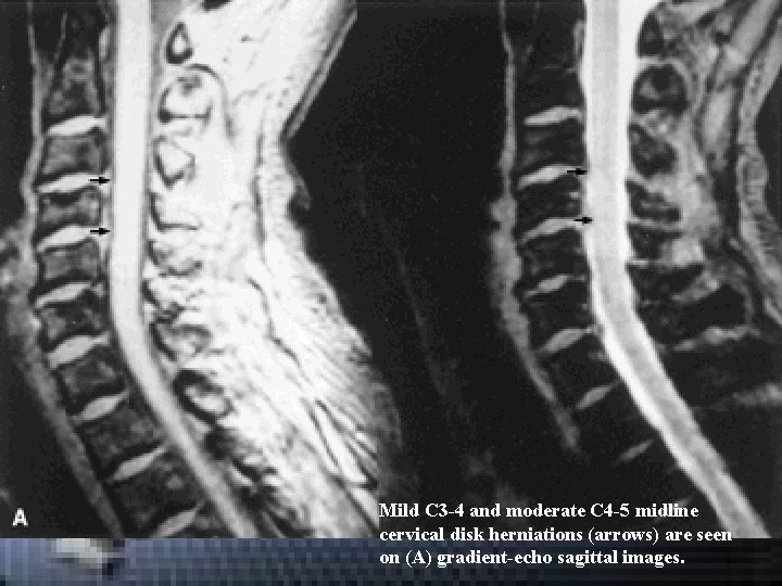 Mild C 3 -4 and moderate C 4 -5 midline cervical disk herniations (arrows) Mild C 3 -4 and moderate C 4 -5 midline cervical disk herniations (arrows)