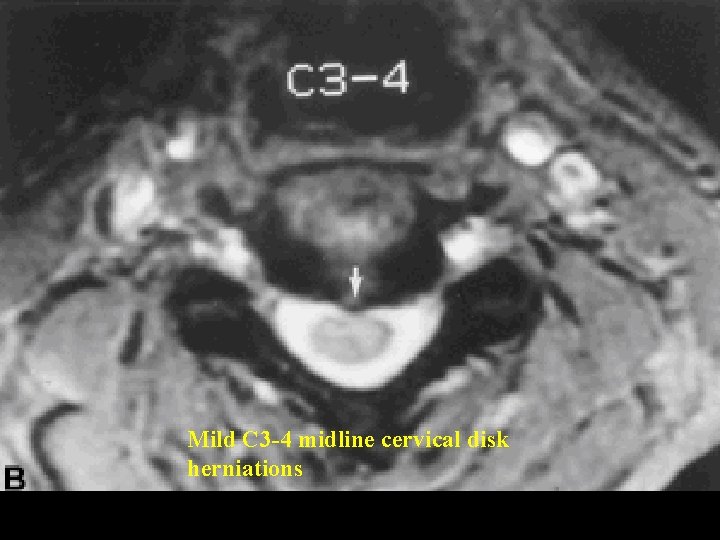 Mild C 3 -4 midline cervical disk herniations Mild C 3 -4 midline cervical disk herniations