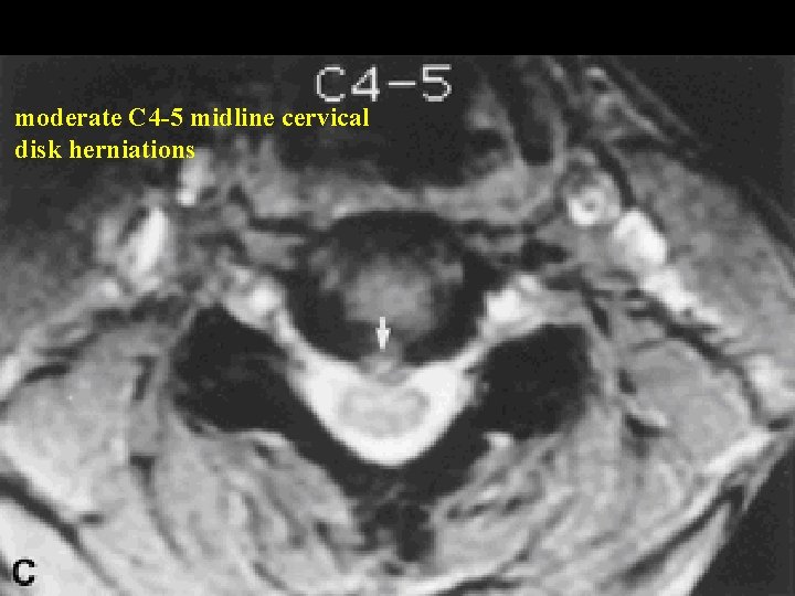 moderate C 4 -5 midline cervical disk herniations moderate C 4 -5 midline cervical disk herniations