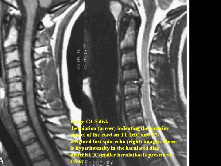Large C 4 -5 disk herniation (arrow) indenting the anterior aspect of the cord Large C 4 -5 disk herniation (arrow) indenting the anterior aspect of the cord