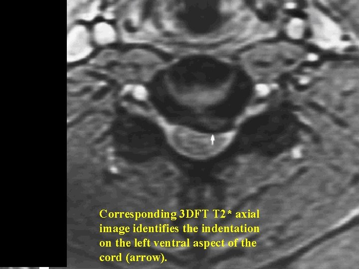 Corresponding 3 DFT T 2* axial image identifies the indentation on the left ventral Corresponding 3 DFT T 2* axial image identifies the indentation on the left ventral