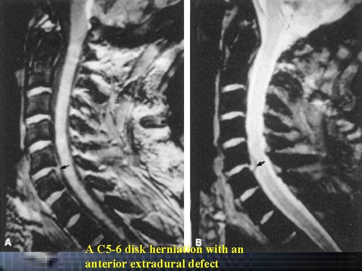 A C 5 -6 disk herniation with an anterior extradural defect A C 5 -6 disk herniation with an anterior extradural defect