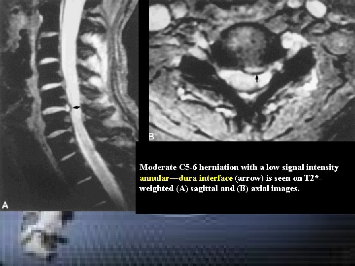 Moderate C 5 -6 herniation with a low signal intensity annular—dura interface (arrow) is Moderate C 5 -6 herniation with a low signal intensity annular—dura interface (arrow) is