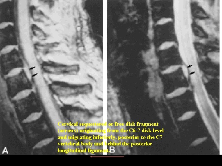 Cervical sequestered or free disk fragment (arrows) originating from the C 6 -7 disk Cervical sequestered or free disk fragment (arrows) originating from the C 6 -7 disk