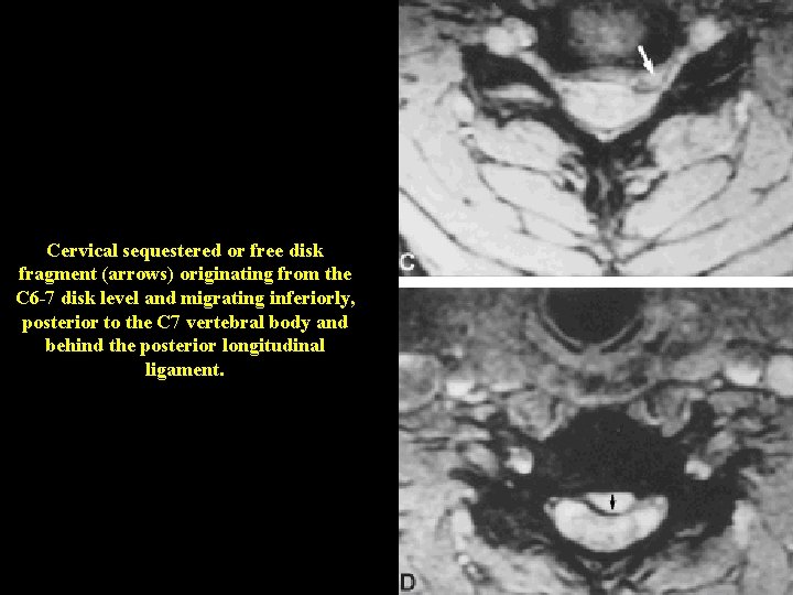 Cervical sequestered or free disk fragment (arrows) originating from the C 6 -7 disk Cervical sequestered or free disk fragment (arrows) originating from the C 6 -7 disk