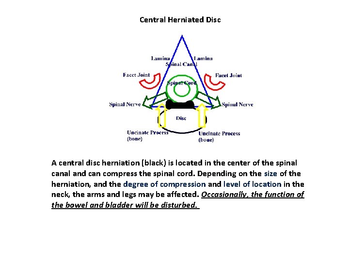 Central Herniated Disc A central disc herniation (black) is located in the center of Central Herniated Disc A central disc herniation (black) is located in the center of
