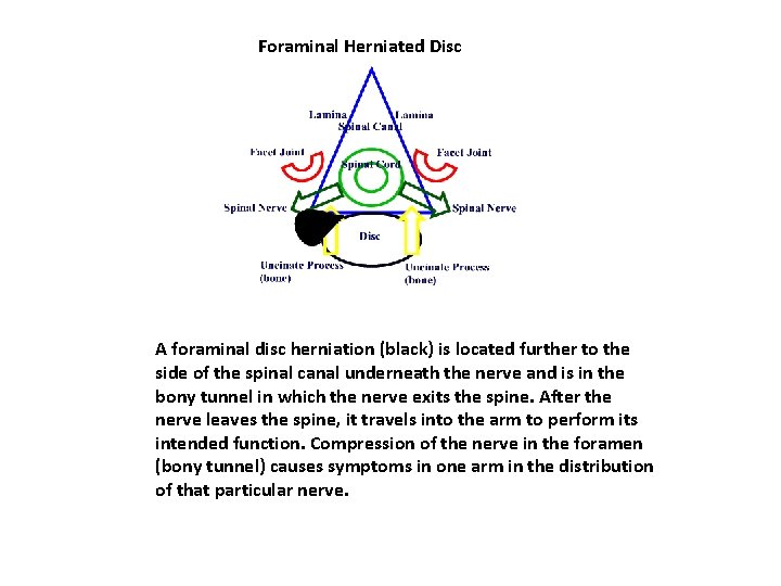 Foraminal Herniated Disc A foraminal disc herniation (black) is located further to the side Foraminal Herniated Disc A foraminal disc herniation (black) is located further to the side