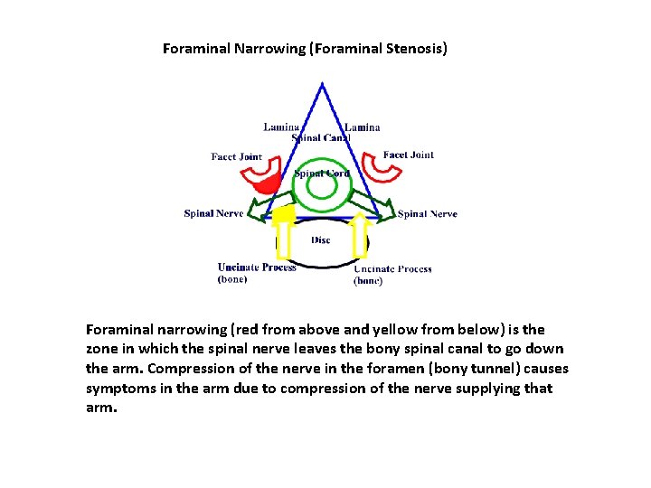 Foraminal Narrowing (Foraminal Stenosis) Foraminal narrowing (red from above and yellow from below) is Foraminal Narrowing (Foraminal Stenosis) Foraminal narrowing (red from above and yellow from below) is