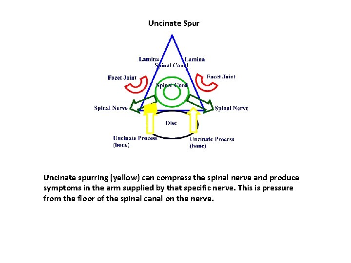 Uncinate Spur Uncinate spurring (yellow) can compress the spinal nerve and produce symptoms in Uncinate Spur Uncinate spurring (yellow) can compress the spinal nerve and produce symptoms in