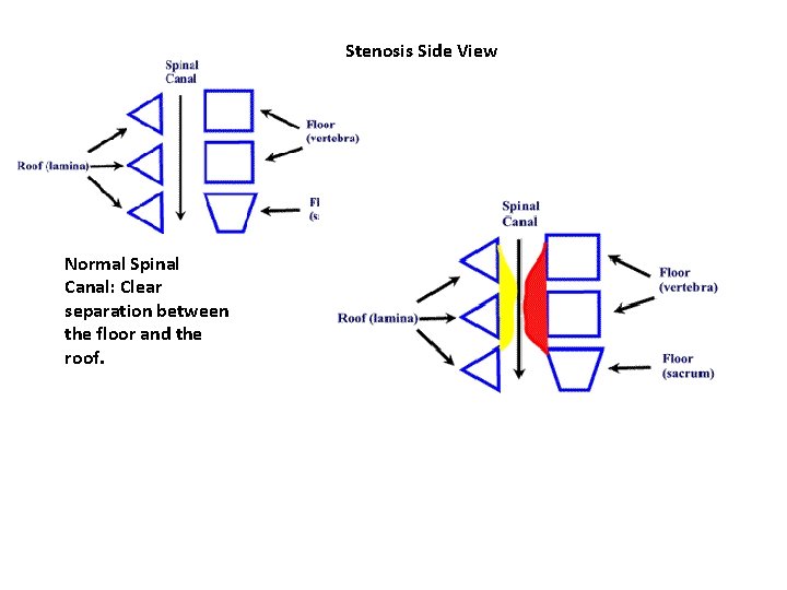 Stenosis Side View Normal Spinal Canal: Clear separation between the floor and the roof. Stenosis Side View Normal Spinal Canal: Clear separation between the floor and the roof.