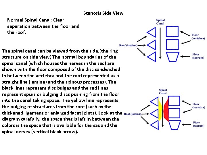 Stenosis Side View Normal Spinal Canal: Clear separation between the floor and the roof. Stenosis Side View Normal Spinal Canal: Clear separation between the floor and the roof.