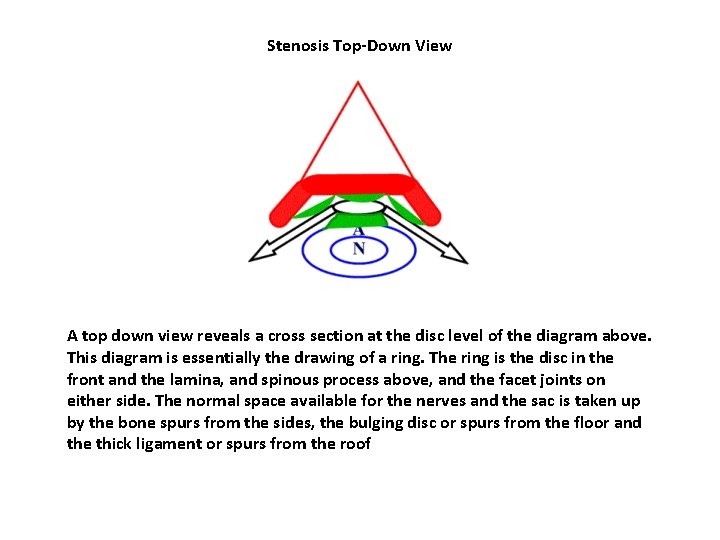 Stenosis Top-Down View A top down view reveals a cross section at the disc Stenosis Top-Down View A top down view reveals a cross section at the disc