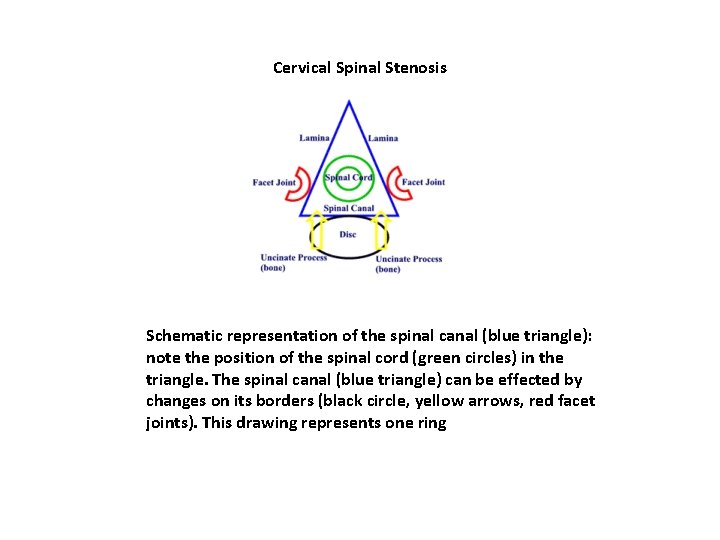 Cervical Spinal Stenosis Schematic representation of the spinal canal (blue triangle): note the position Cervical Spinal Stenosis Schematic representation of the spinal canal (blue triangle): note the position