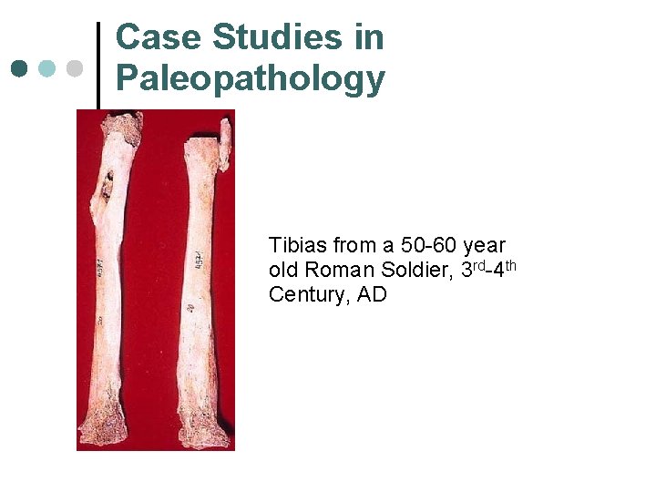 Case Studies in Paleopathology Tibias from a 50 -60 year old Roman Soldier, 3