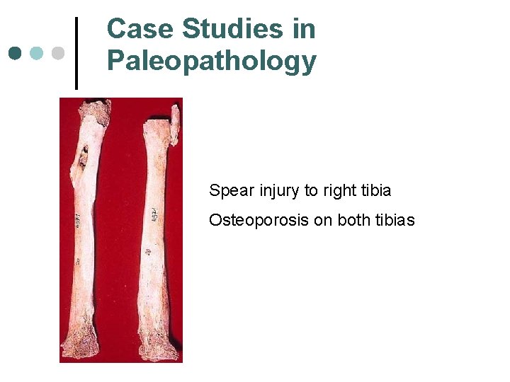 Case Studies in Paleopathology Spear injury to right tibia Osteoporosis on both tibias 